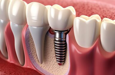 Implante dentário: respostas das principais dúvidas