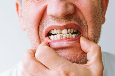 Doença Periodontal: Causas, Sintomas e Tratamentos