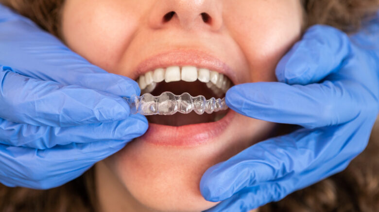 Dentista em luvas aplicando alinhador invisível em dentes de paciente