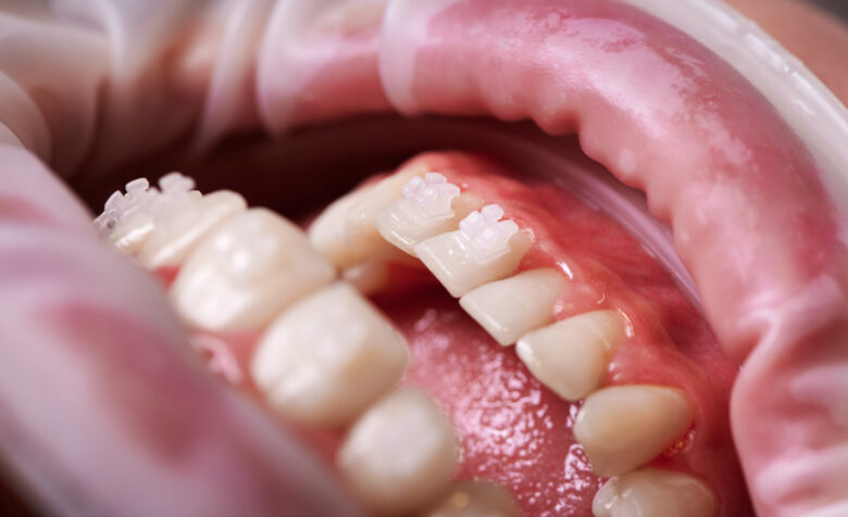 Gengivite é um problema periodontal