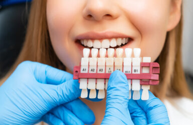 Facetas de porcelana: transforme seu sorriso com naturalidade e durabilidade