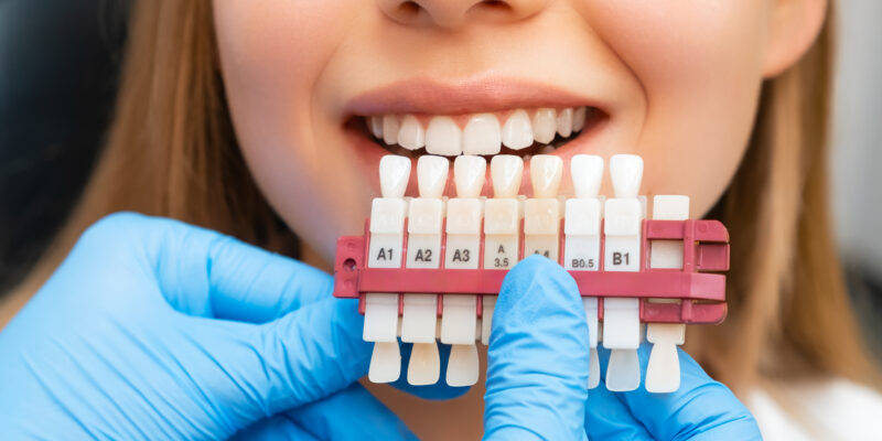 Facetas de porcelana: transforme seu sorriso com naturalidade e durabilidade Facetas de porcelana: transforme seu sorriso com naturalidade e durabilidade