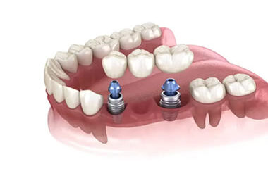 implante-dentario