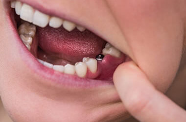 prótese-dentária-