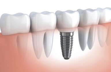 protese-dentaria-versus-implante-dentario protese-dentaria-versus-implante-dentario
