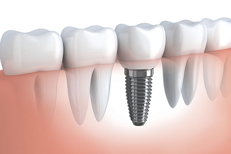protese-dentaria-versus-implante-dentario